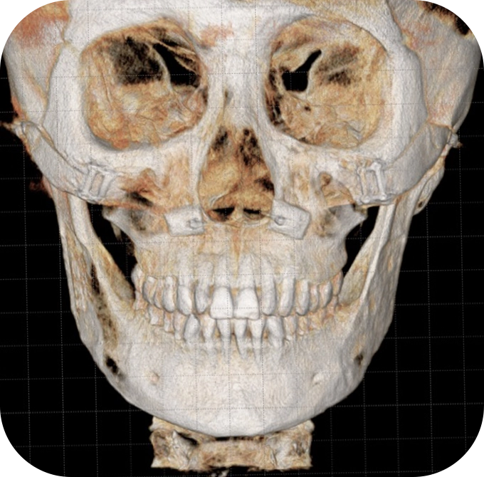 3D CT scan of skull for plastic surgery where natural 345 plastic surgery