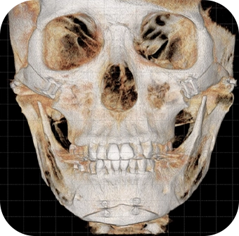345 plastic surgery skull X-ray showing natural facial bone structure for cosmetic procedures