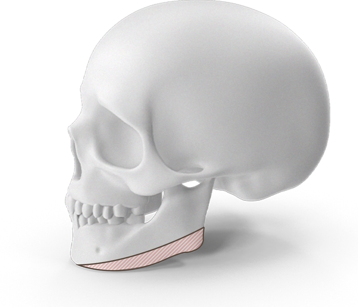 Skull showing chin augmentation for 345 plastic surgery where natural results.