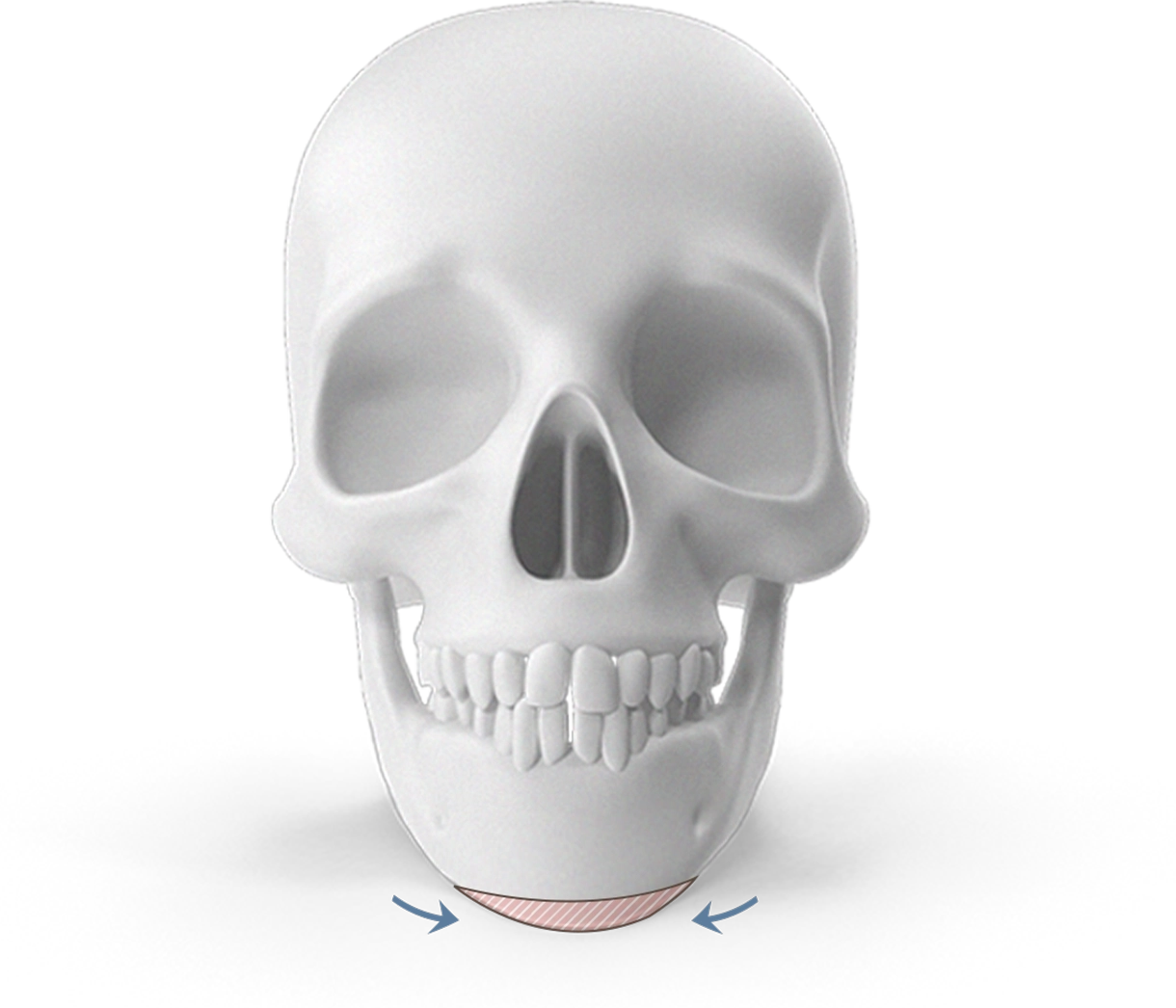 Skull showing chin augmentation for plastic surgery where natural 345.