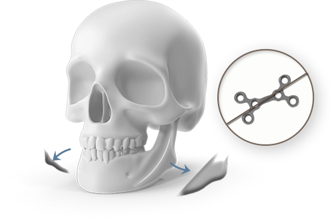 Skull with osteotomy for 345 plastic surgery where natural jaw reshaping.