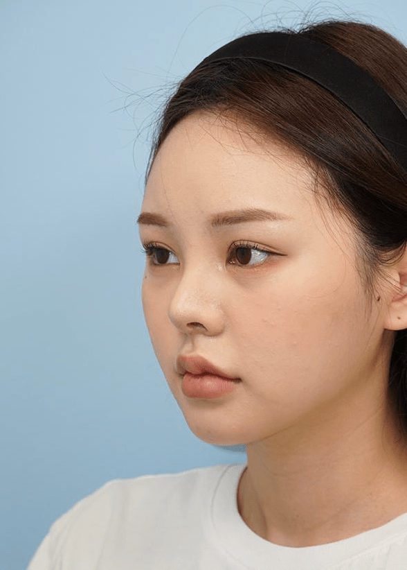 Asian woman with natural look after 345 plastic surgery. Cosmetic procedure results.