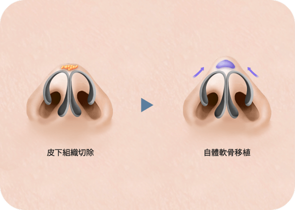 鼻部手術示意圖，切除組織與移植軟骨
