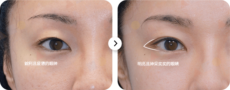 眼睛手術前後對比圖