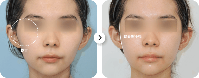 Before and after cheekbone surgery comparison.
