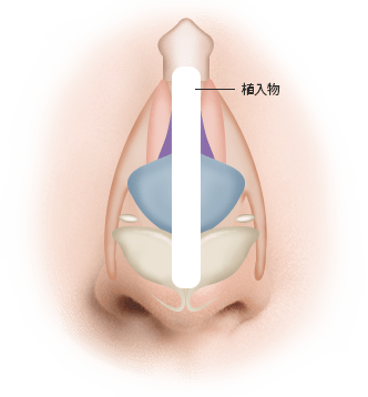 鼻子解剖圖，顯示鼻腔內部結構與植入物。圖示可能與 345 Plastic Surgery 的隆鼻手術或鼻整形相關。鼻中隔、鼻甲等細節可見，白色植入物模擬手術效果。此圖用於說明整形手術如何改變鼻部結構，提升外觀。