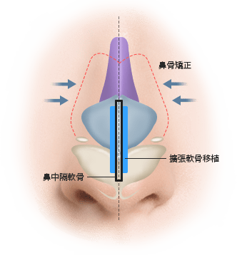 鼻部位結構示意圖，包含矯正與移植
