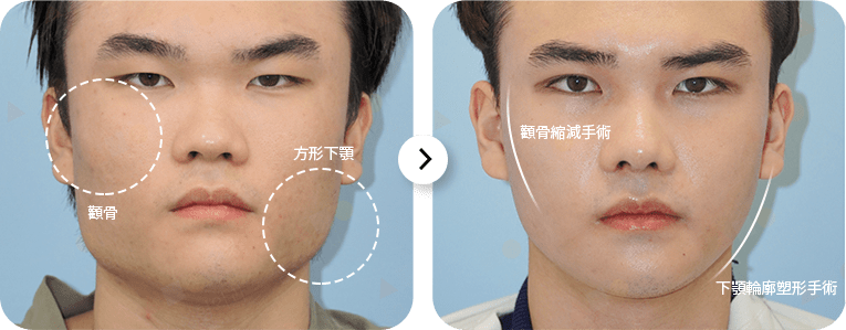 Before and after facial surgery comparison photo.