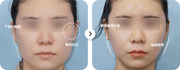 Before and after cosmetic facial surgery transformation.