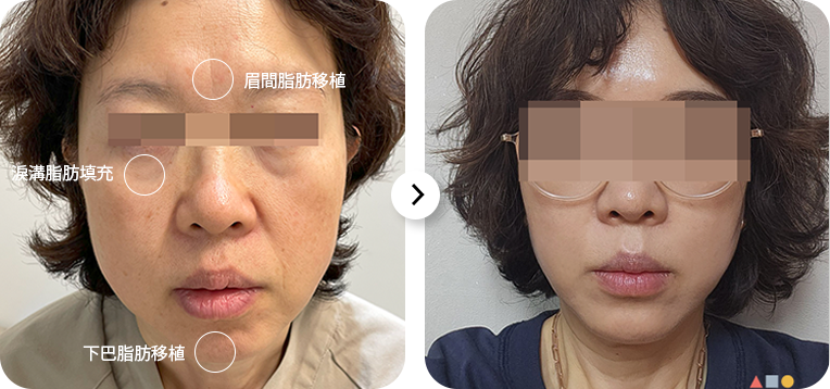 Before and after face treatment comparison.