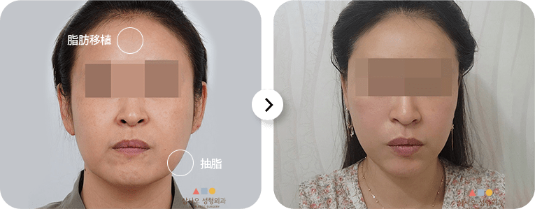 Before and after cosmetic procedure on woman's face.