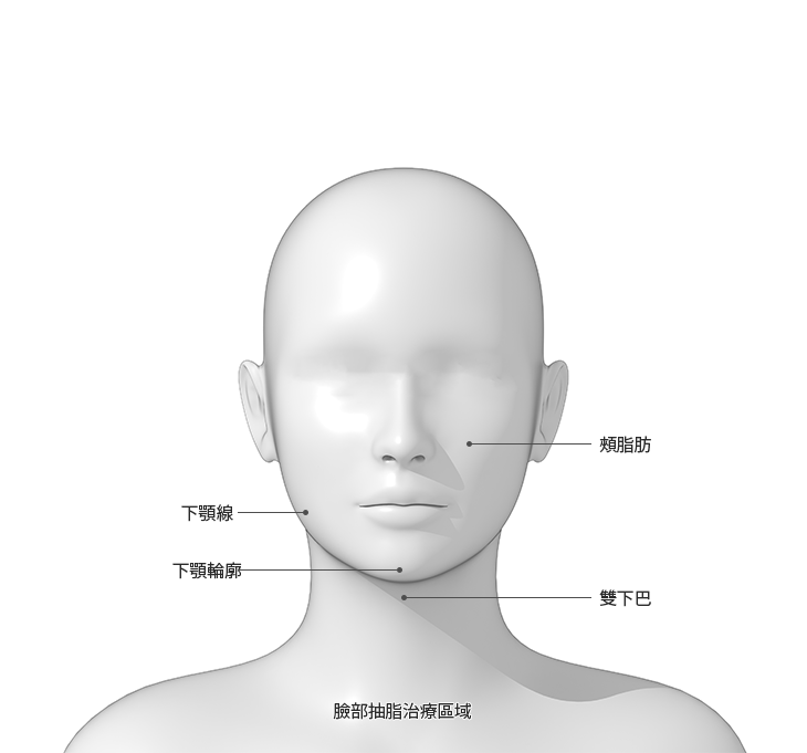 Facial liposuction treatment areas diagram in Chinese.