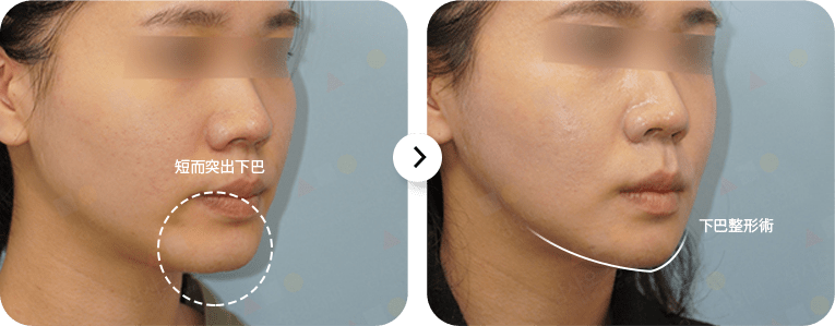 Before and after chin surgery comparison.