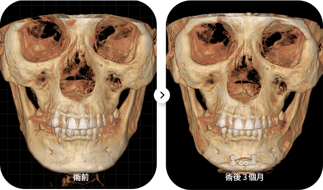 Before and after skull surgery comparison