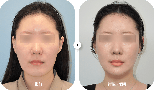 Before and after face cosmetic surgery comparison photo.