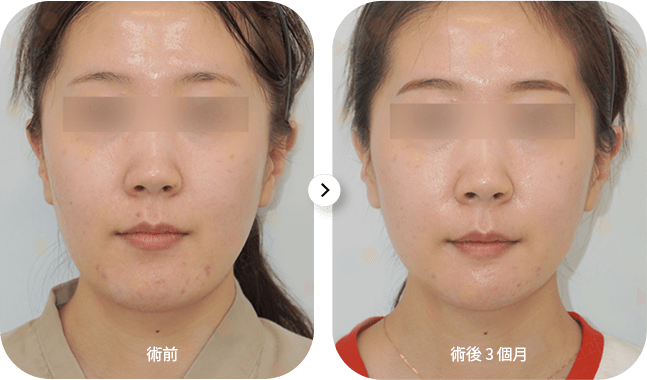 Before and after acne treatment face photos.