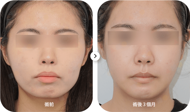 Facial skin before and after treatment comparison.