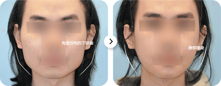 Before and after jawline surgery comparison.