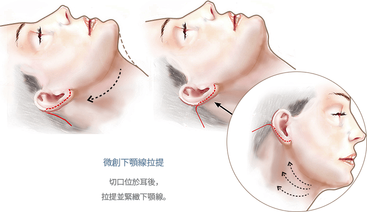 Facelift procedure illustration with chin and ear focus.