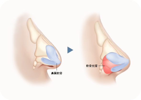 鼻翼軟骨支撐圖解