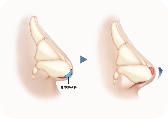 鼻整形前後對比圖，鼻中隔軟骨手術