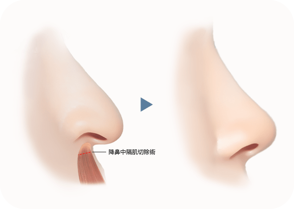 隆鼻前後鼻中隔軟骨手術圖示