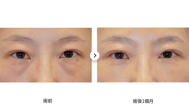 眼部手術前後對比