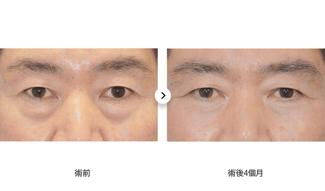 眼部手術前後對比，術前與術後4個月