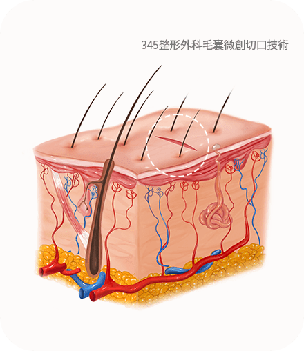 Illustration of human skin cross-section with hair follicles.