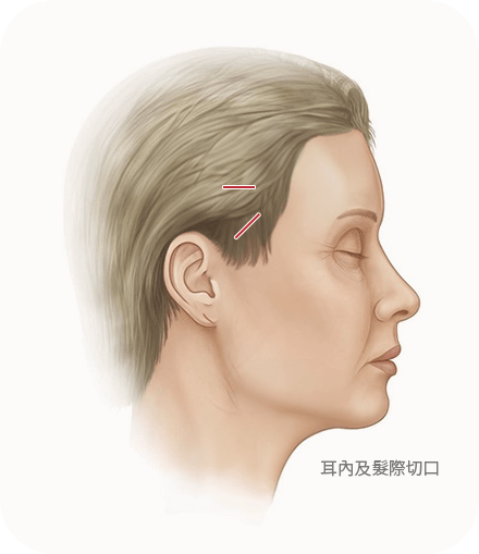女性側臉圖，標示耳內及髮際切口位置，用於說明 345 Plastic Surgery 的手術方式。此圖可能用於頁面標題為「拉皮手術」或內容提及「345 Plastic Surgery 拉皮技術」的頁面，展示手術切口位置。