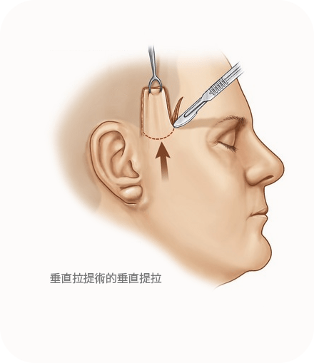 Illustration of facial skin lifting surgery