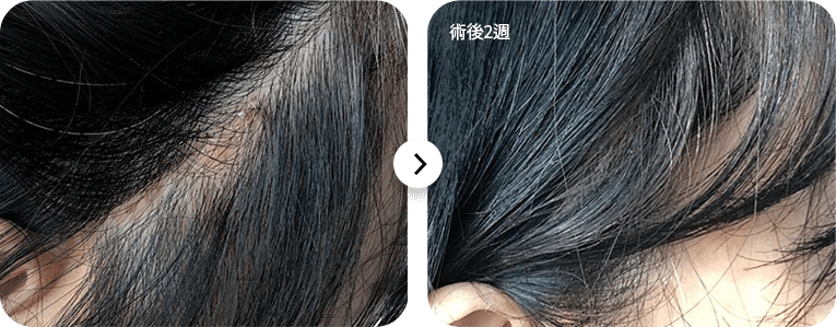 Hair restoration before and after two weeks.