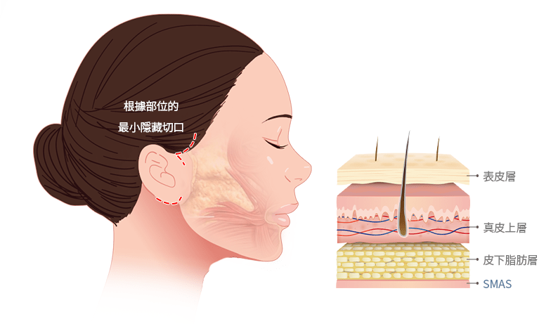Facelift incision and skin layer diagram