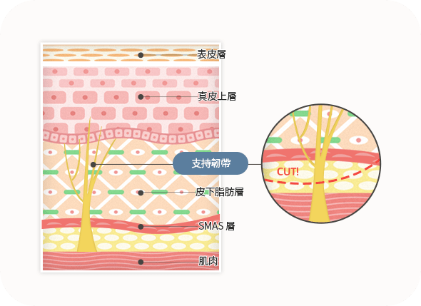 Illustration of skin layers with labeled cut section.