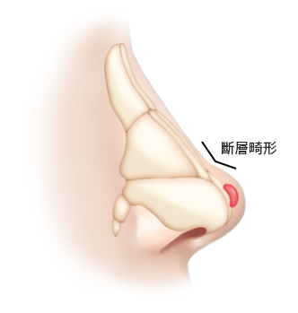 鼻中膈軟骨示意圖，顯示鼻部結構