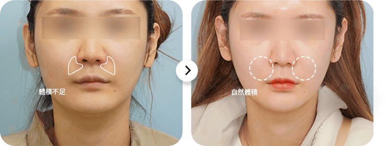 Before and after nose contouring comparison photo.