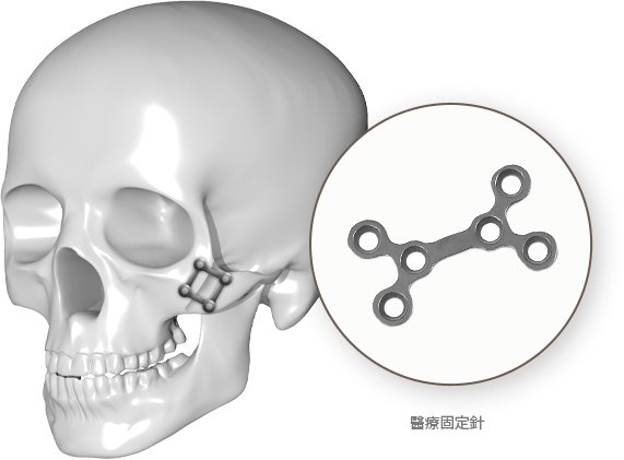 Skull with surgical plate model