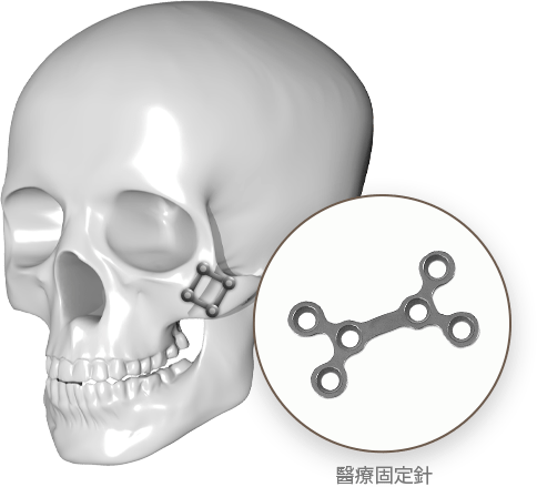 Skull with metal implant illustration