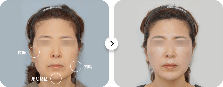 Before and after cosmetic facial treatment comparison.