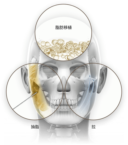 Illustration of facial fat transfer process in three steps.