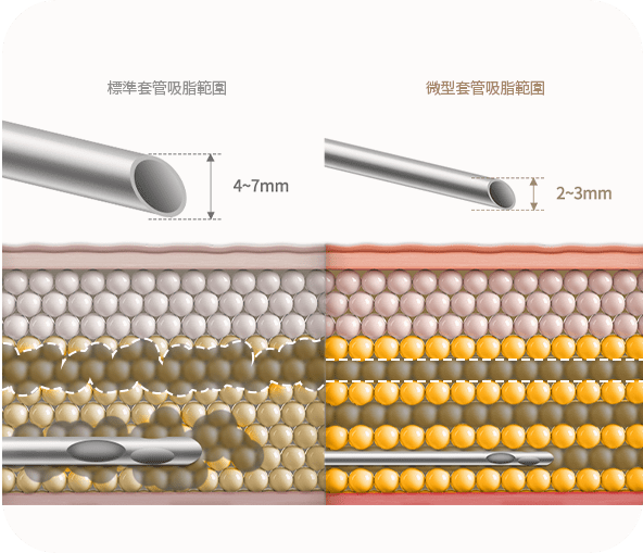 Comparison of standard and micro liposuction cannulas.
