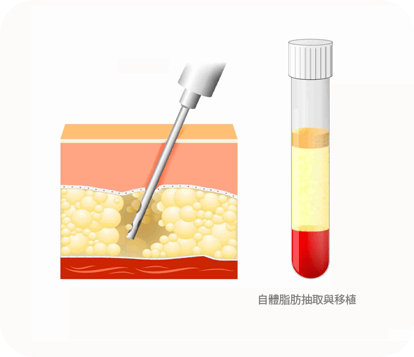 Illustration of fat extraction process and collected sample.