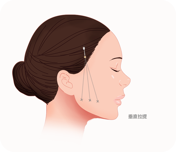 Illustration of facial thread lift procedure