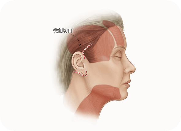 Facelift incision diagram on woman's face profile.