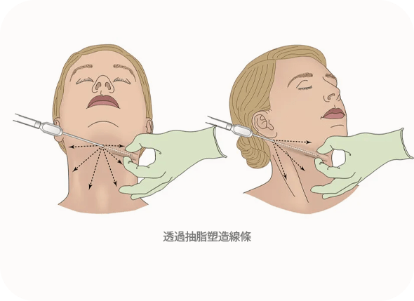 Illustration of chin liposuction procedure steps.
