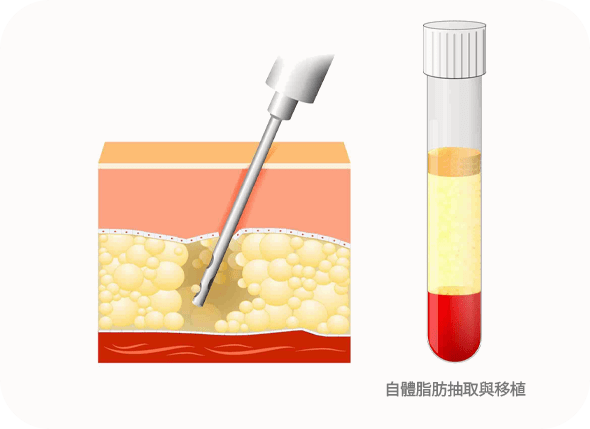Illustration of fat extraction and transfer procedure.