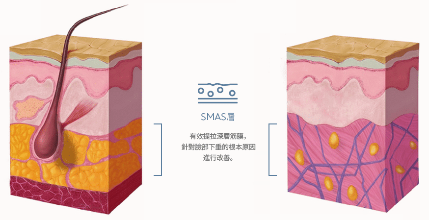 Diagram of skin layers with hair follicle and SMAS.