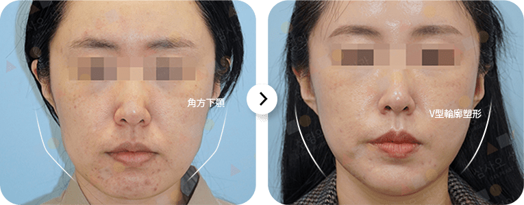 Before and after facial contouring transformation
